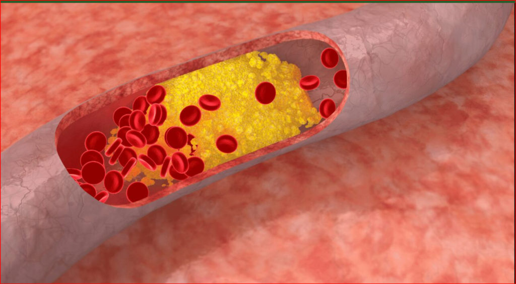 ad Cholesterol