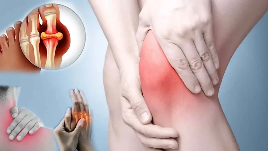 Arthritis Home Remedies