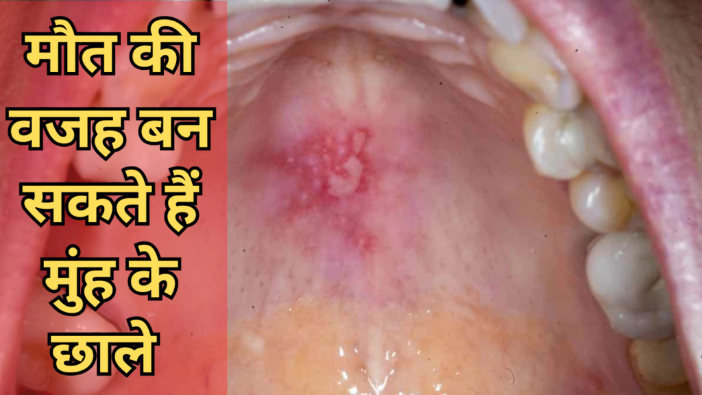 Mouth Ulcers: